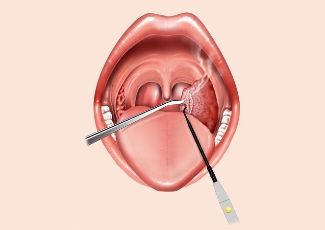 tonsillotomie