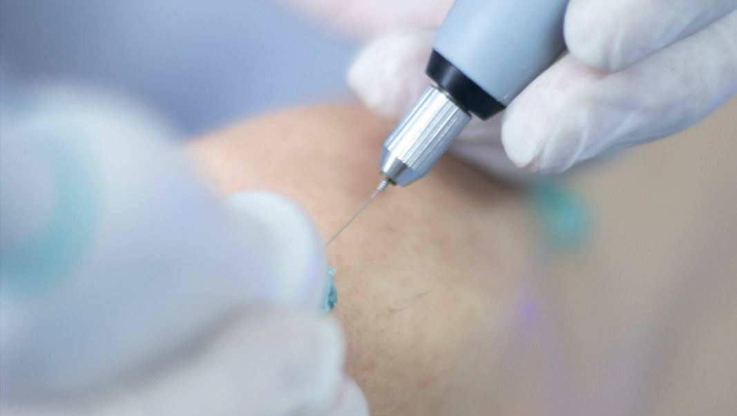 Infiltración articular guiada por ecografía
